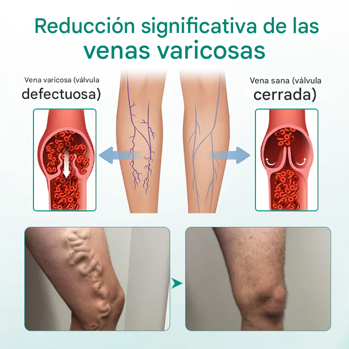 TIMILK (set x 8) parches para la circulacion y venas varicosas