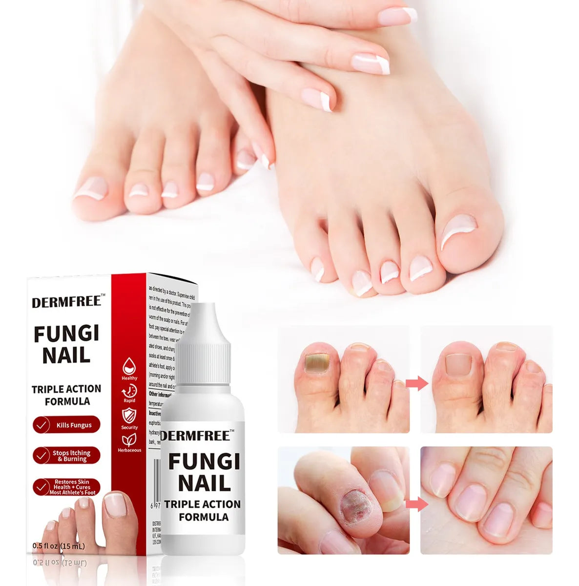 Fungi Nail ™ – Tratamiento Para El Cuidado De Uñas
