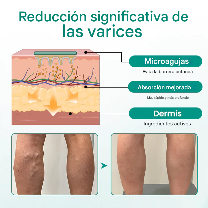 TIMILK (set x 8) parches para la circulacion y venas varicosas