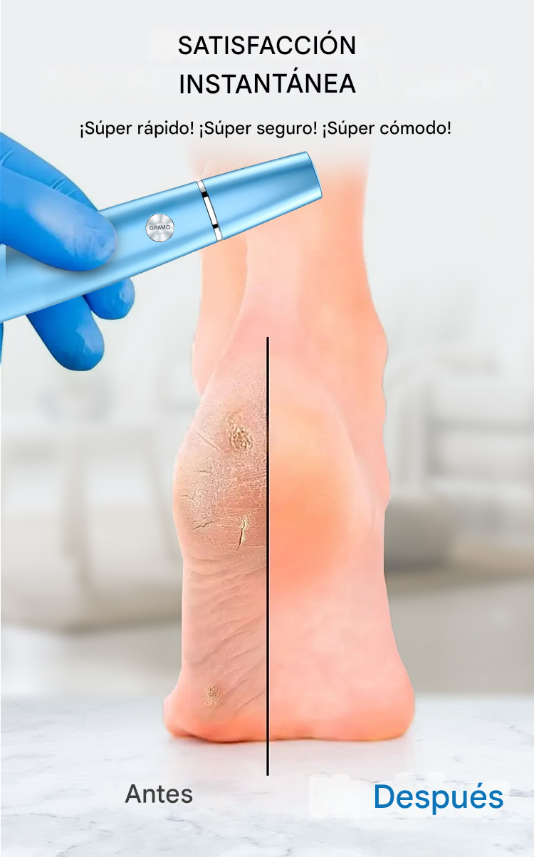 SoftFeet™ ProCare - Removedor Eléctrico De Callos Profesional
