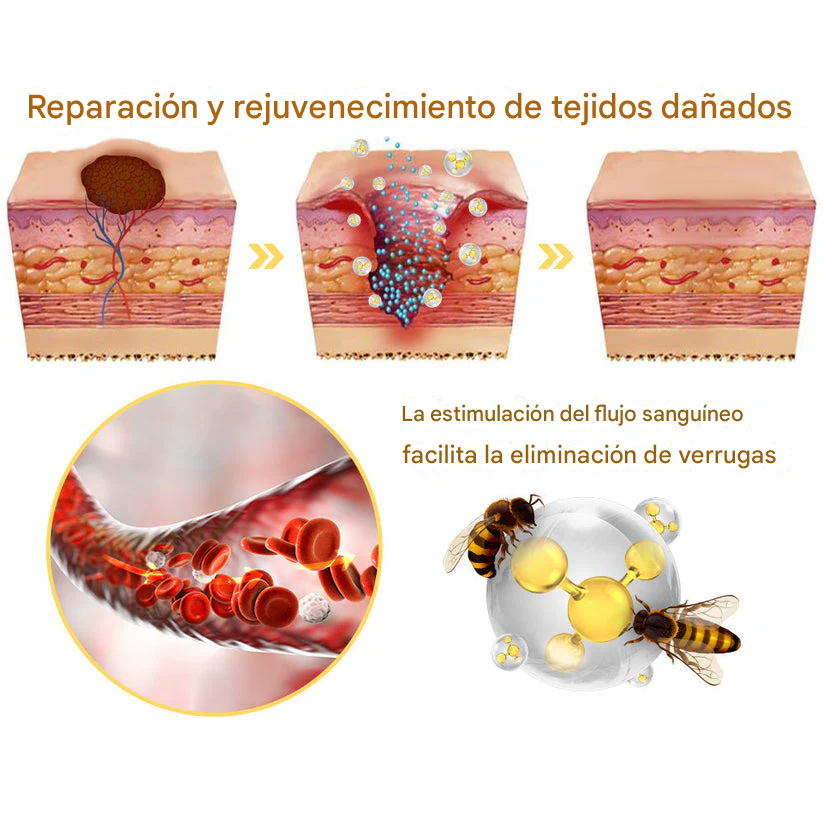 PROMO 2X1 🔥🐝Tratamiento En Aerosol Con Veneno De Abeja Para Lunares Y Verrugas