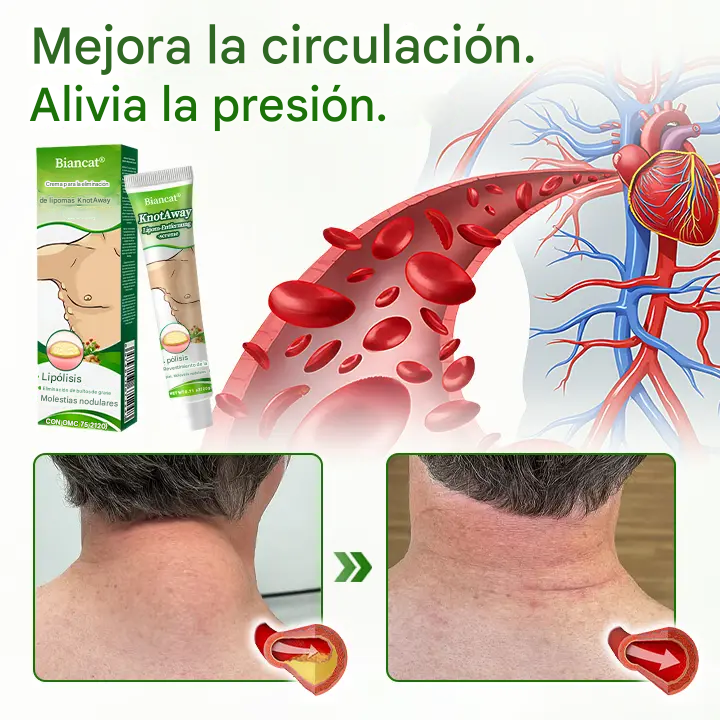 Biancat® - Crema Para La Eliminación De Lipomas