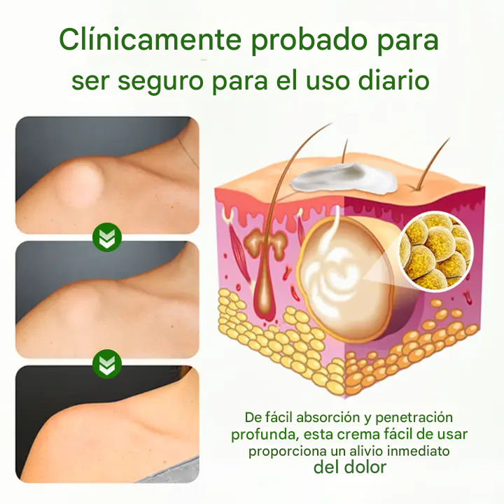 Biancat® - Crema Para La Eliminación De Lipomas