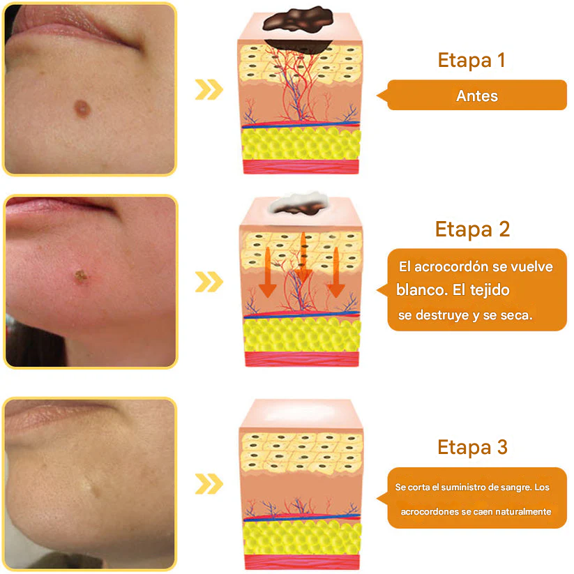 PROMO 2X1 🔥🐝Tratamiento En Aerosol Con Veneno De Abeja Para Lunares Y Verrugas