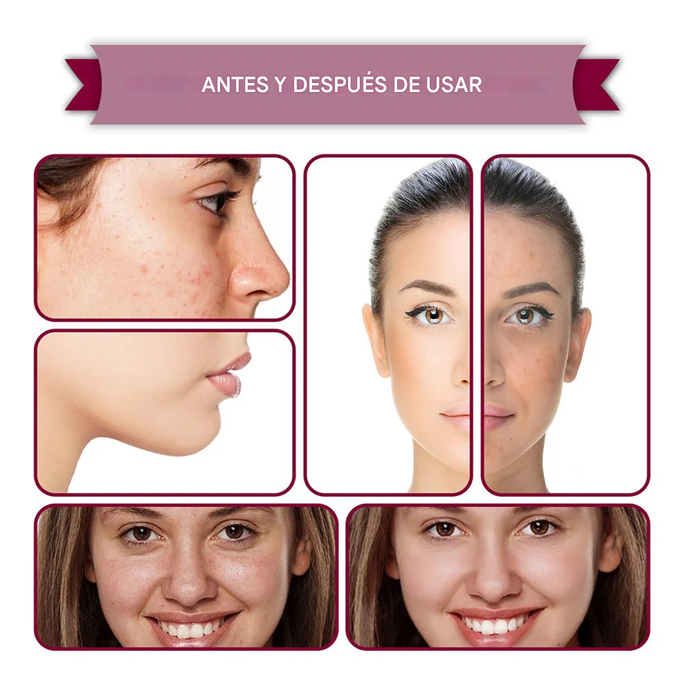 SÉRUM ANTI-ACNÉ - ELIMINACIÓN INSTANTÁNEA