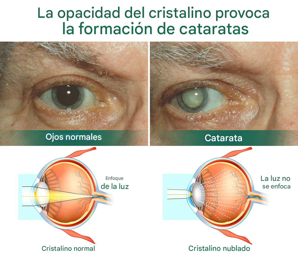 Ourlyard® - Gotas Para Los Ojos - Apto para presbicia, síndrome del ojo seco, glaucoma y cataratas