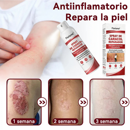 Spray De Cadacol Reparador Para piel Con Psoriasis, Picazón Y Descamación