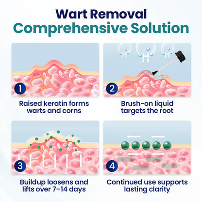 Timilk® WartLift - Líquido para eliminar callos, verrugas e imperfecciones