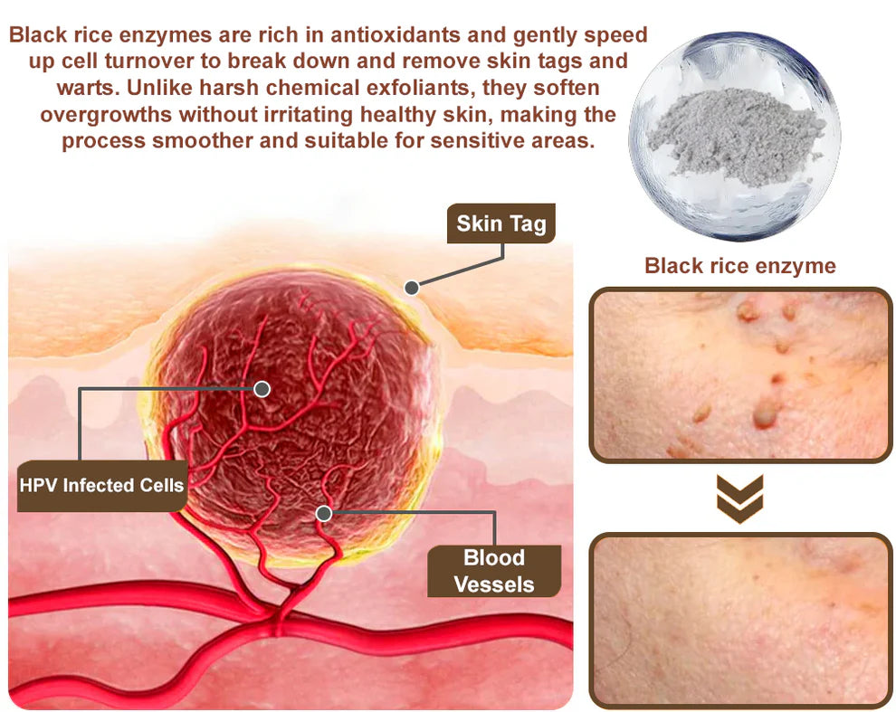 ✅ Crema con extracto de salvado de arroz Zvoevo® 👩‍⚕️ Certificada por TGA (Para eliminar verrugas y crecimientos de la piel, eliminar la hiperplasia de la piel y la acumulación de queratina, tratar el cáncer de piel)