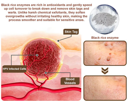✅ Crema con extracto de salvado de arroz Zvoevo® 👩‍⚕️ Certificada por TGA (Para eliminar verrugas y crecimientos de la piel, eliminar la hiperplasia de la piel y la acumulación de queratina, tratar el cáncer de piel)