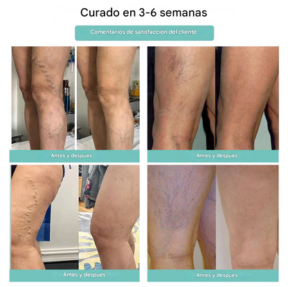 ✨ Descuento de último día🌸 Parche para venas varicosas LOVILDS™ Leech (8 pcs)