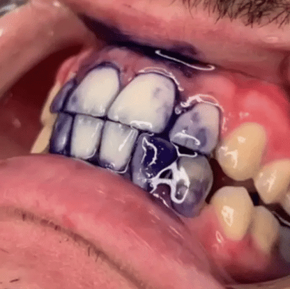 PURPLE V34 - Blanqueador Dental