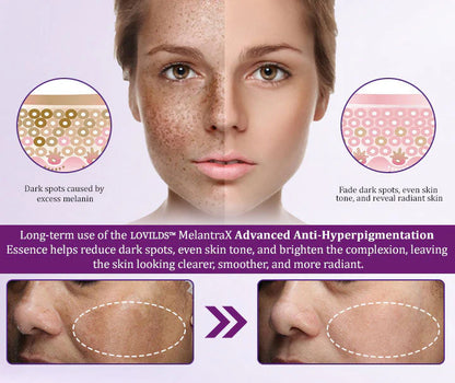 LOVILDS™ MelantraX Esencia antihiperpigmentación avanzada