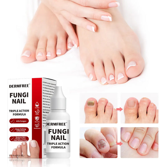 Fungi Nail ™ – Tratamiento Para El Cuidado De Uñas