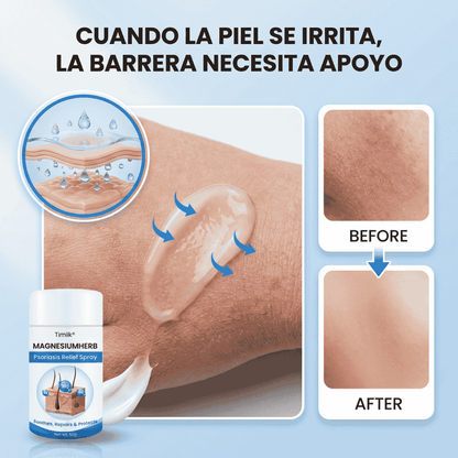 MagnesiumHerb - Spray Para El Alivio De La Psoriasis