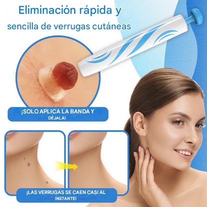TagBuddy Pro™ - Kit de eliminador de Verrugas