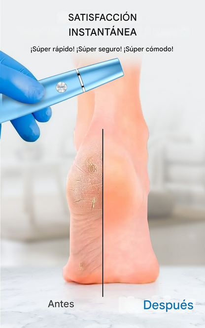SoftFeet™ ProCare - Removedor Eléctrico De Callos Profesional