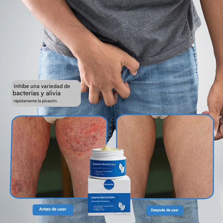 DermaCalm Magnesio Herbal Intimate - Alivio Rápido Para La Psoriasis, El Eccema Y La Picazón