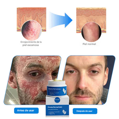 DermaCalm Magnesio Herbal Intimate - Alivio Rápido Para La Psoriasis, El Eccema Y La Picazón