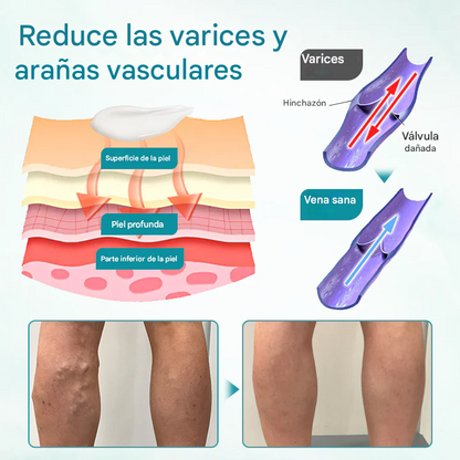 🔥PROMO 2x1 🎁- Crema Para Aliviar Las Venas Timilk® VeinAway