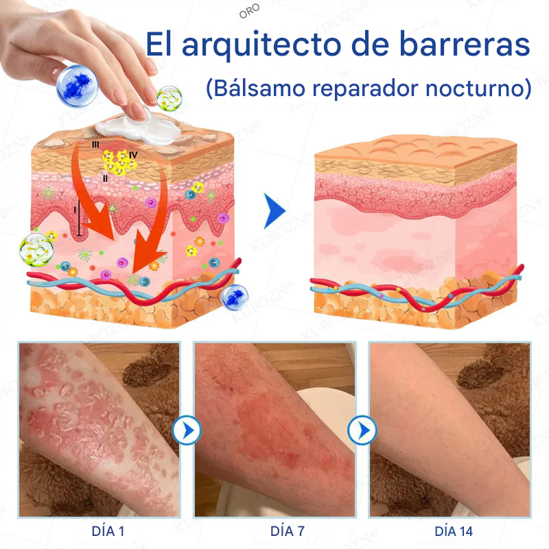 Sistema De Reparación Diurna Y Nocturna Para La Psoriasis: Dúo De Alivio 100 % Libre De Esteroides Para Placas, Descamación Y Picazón.