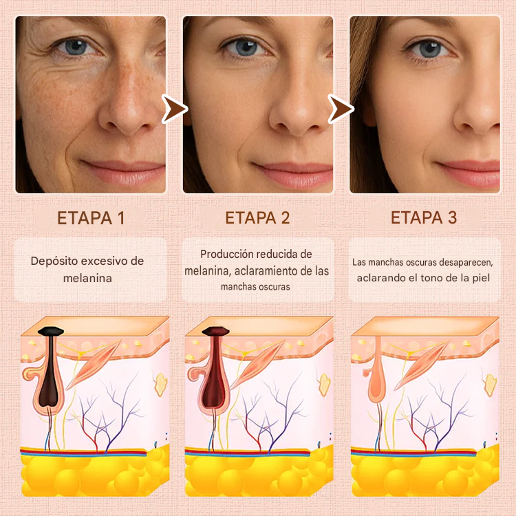 Luhaka® Gel Exfoliante Purificante ACE 3 Para Acantosis Nigricans, Exfoliación, Manchas Oscuras, Acrocordones y Eczema