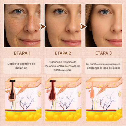Luhaka® Gel Exfoliante Purificante ACE 3 Para Acantosis Nigricans, Exfoliación, Manchas Oscuras, Acrocordones y Eczema