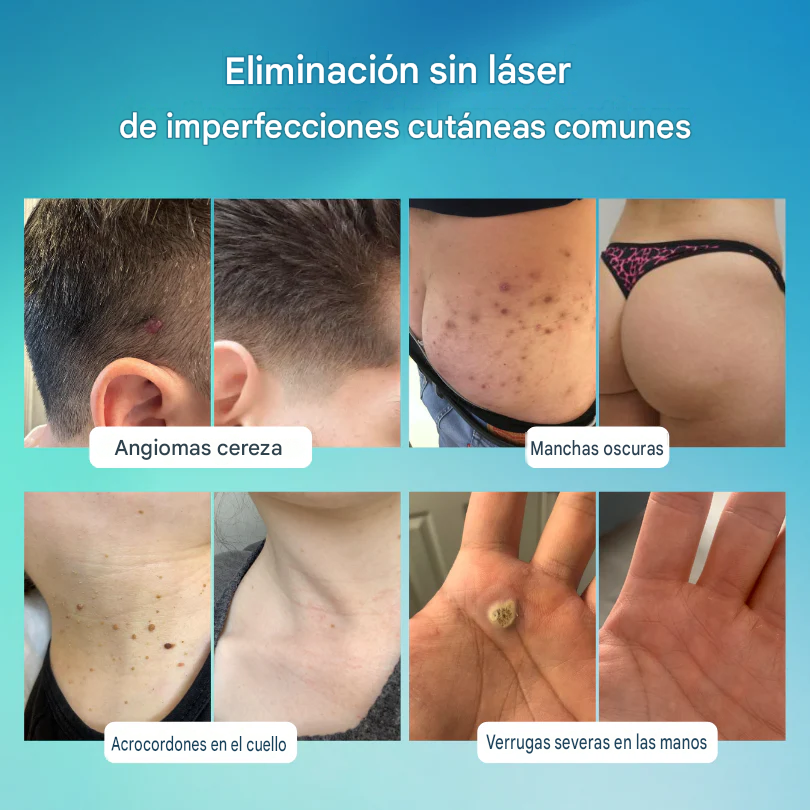 Lápiz De Cuidado Avanzado Para Eliminar Verrugas Y Imperfecciones De La Piel
