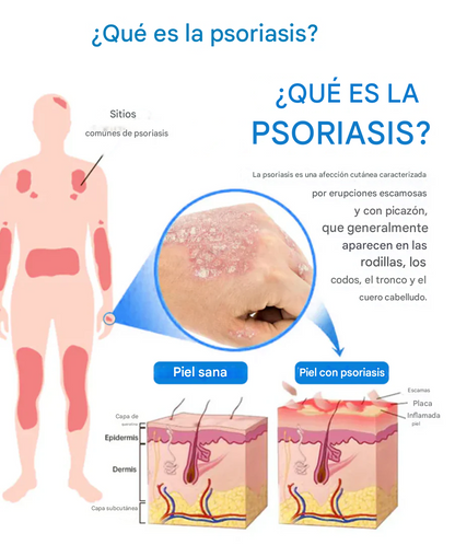 DermaCalm Magnesio Herbal Intimate - Alivio Rápido Para La Psoriasis, El Eccema Y La Picazón