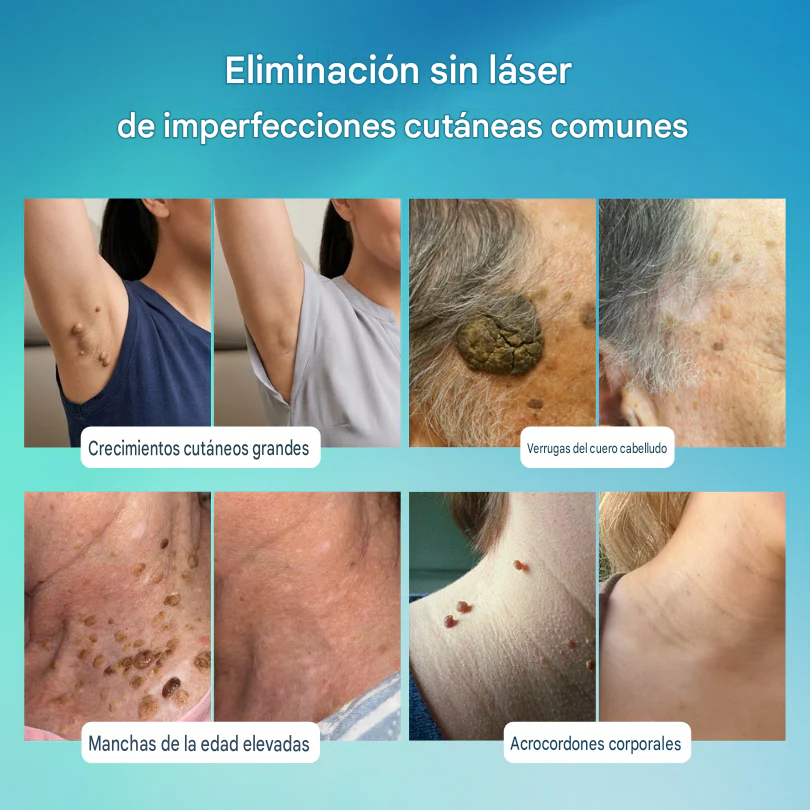 Lápiz De Cuidado Avanzado Para Eliminar Verrugas Y Imperfecciones De La Piel