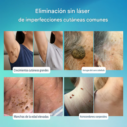 Lápiz De Cuidado Avanzado Para Eliminar Verrugas Y Imperfecciones De La Piel