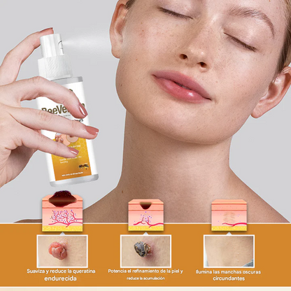 BeeEssence® - Spray Removedor De Verrugas