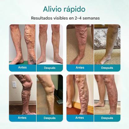 🔥PROMO 2x1 🎁- Crema Para Aliviar Las Venas Timilk® VeinAway