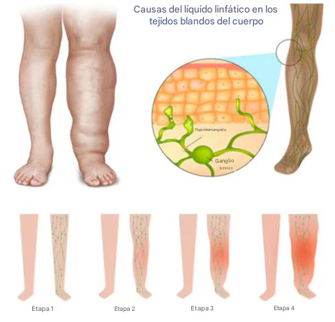 VitaLymph™ - Cuello Ultrasónico Portátil