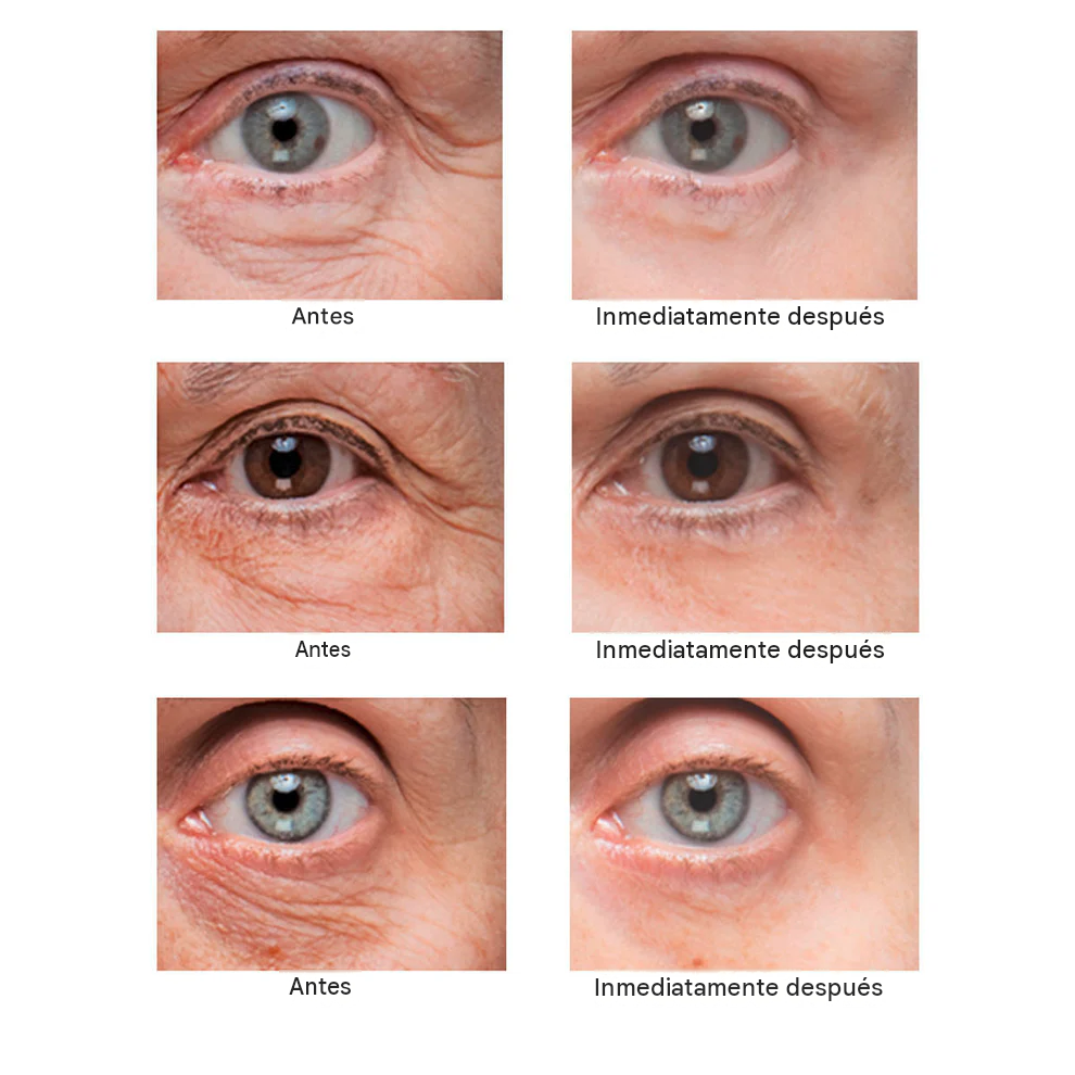 Crema Eliminadora De bolsas Y Arrugas Alrededor De Los Ojos.