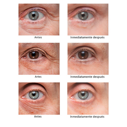 Crema Eliminadora De bolsas Y Arrugas Alrededor De Los Ojos.