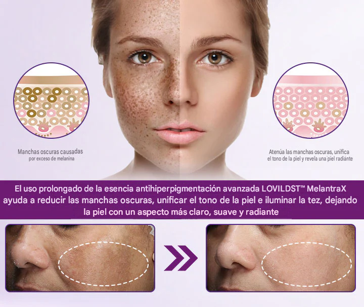 LOVILDS™ MelantraX Esencia Antihiperpigmentación Avanzada