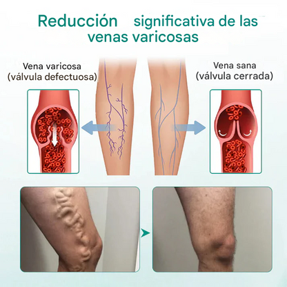 ✨Parche Para Venas Varicosas LOVILDS™ Leech (8 pcs)✨