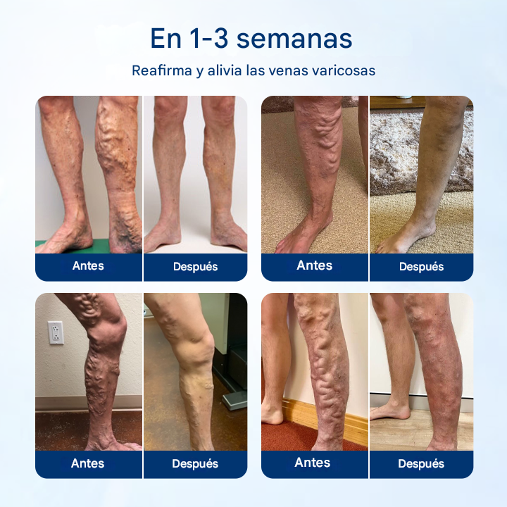 VenoRelief ® Spray Botánico Para Piernas
