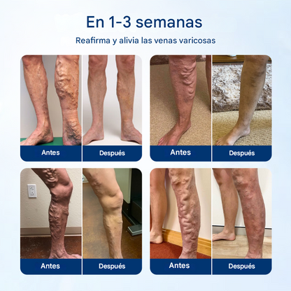 VenoRelief ® Spray Botánico Para Piernas