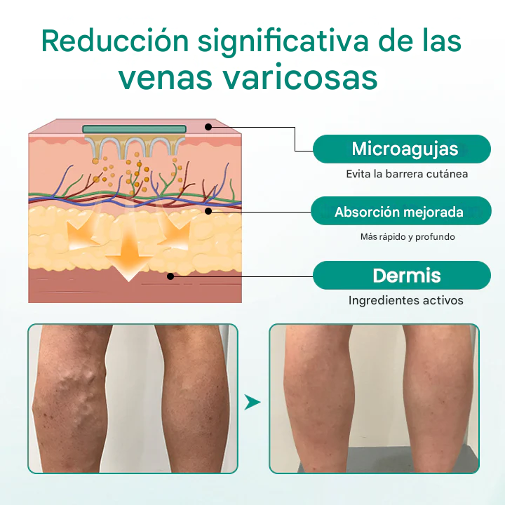 Pack x 24 parches para varices - LegRenew