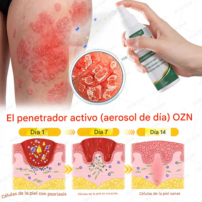 Sistema De Reparación Diurna Y Nocturna Para La Psoriasis: Dúo De Alivio 100 % Libre De Esteroides Para Placas, Descamación Y Picazón.